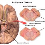 Un Gancio Al Parkinson