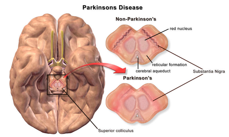 Un Gancio Al Parkinson